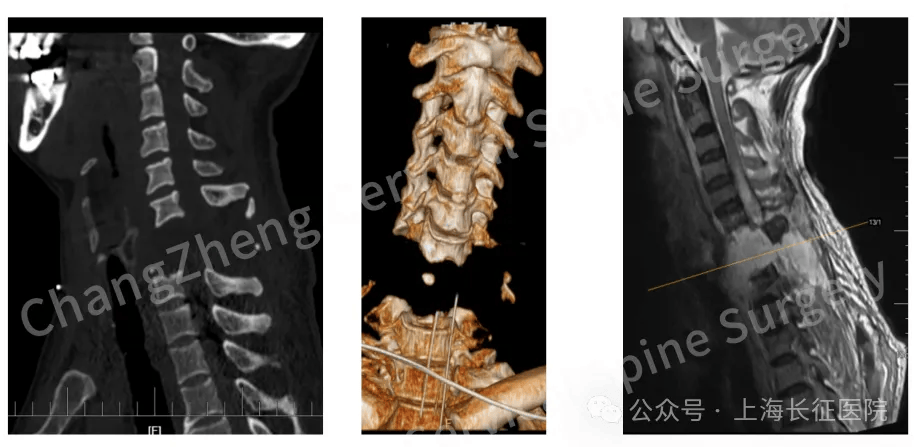 全球罕见！中国医生救回“身首离断”患者